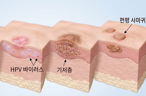편평사마귀, 레이저로 없앴는데 왜 또 재발할까? 관련 해부 구조 그림